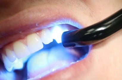 лазерное отбеливание зубов в клинике