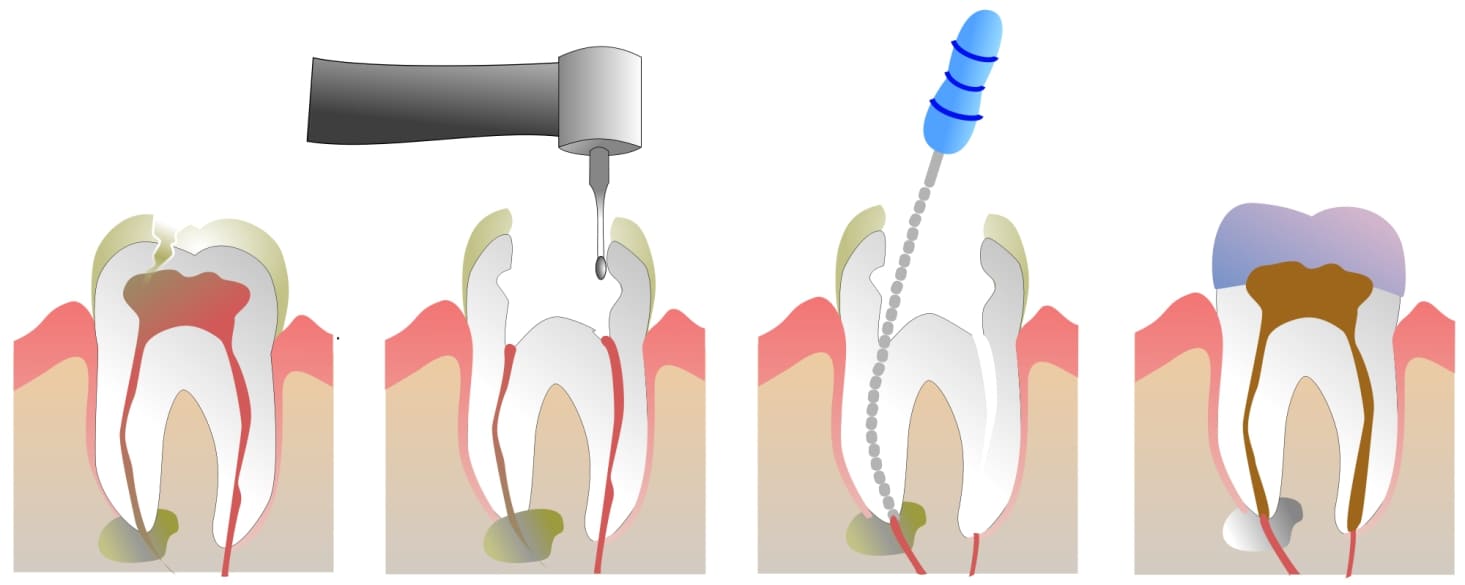 Пломбирование каналов зуба