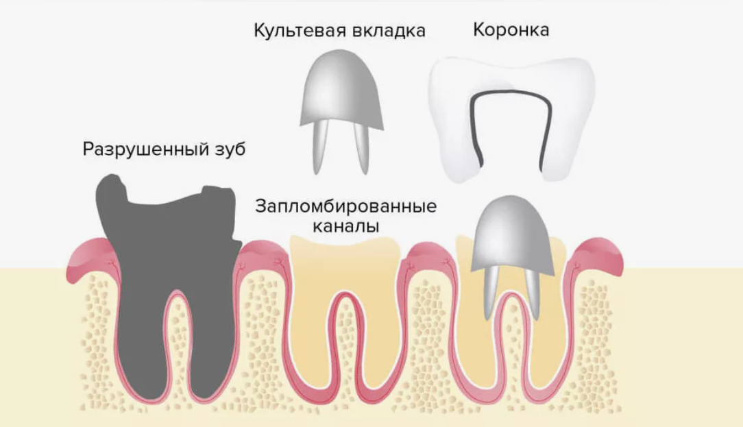 В каких случаях удаляют зуб