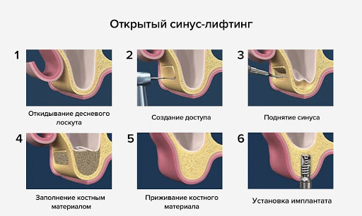 открытый синус-лифтинг