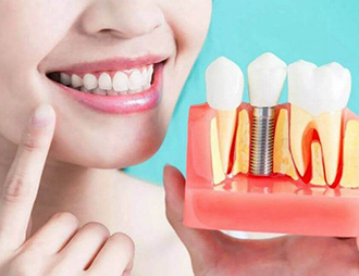 уход за имплантами зубов
