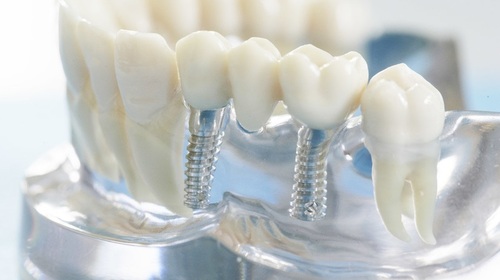 Восстановление зуба на импланте в Иркутске